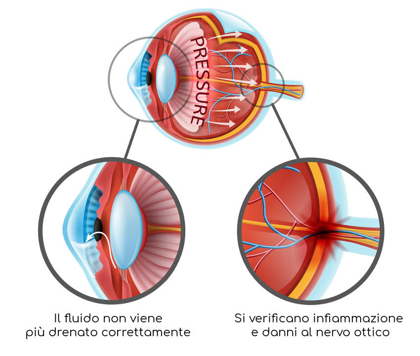 Chirurgia del Glaucoma
