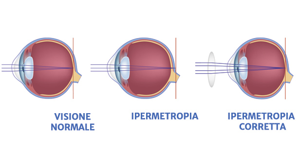 Ipermetropia